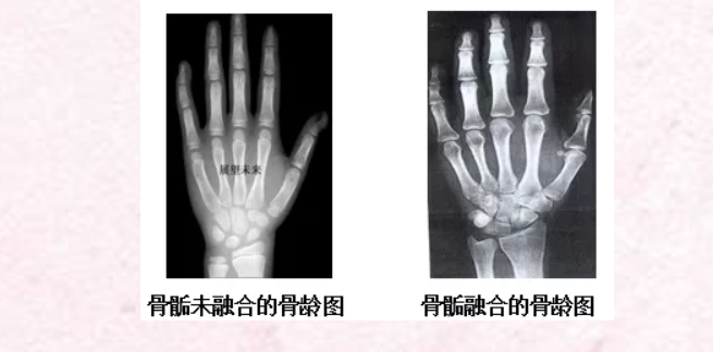 【公益義診】免費測骨齡--關(guān)注身高，助力成長